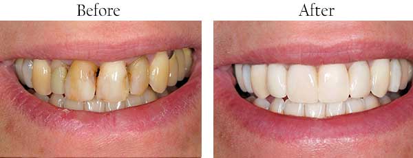 Before & After Photos by Mannheim Dental