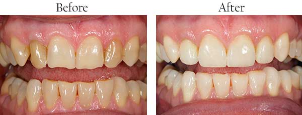 Before & After Photos by Mannheim Dental