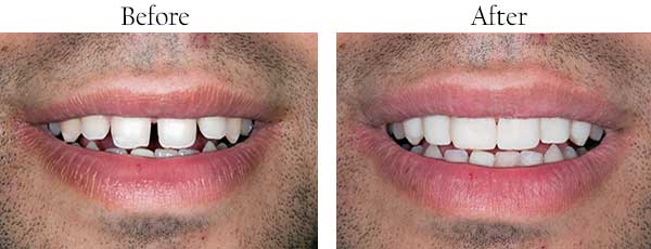 Before & After Photos by Mannheim Dental