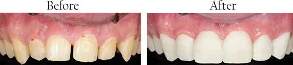 Before & After Photos by Mannheim Dental