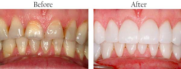 Before & After Photos by Mannheim Dental