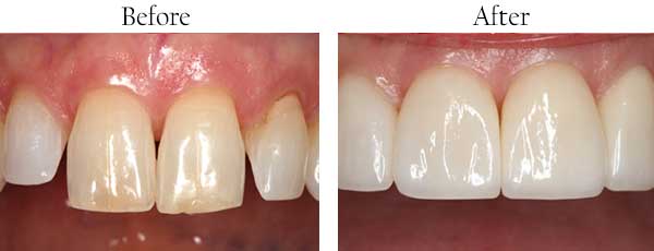 Before & After Photos by Mannheim Dental