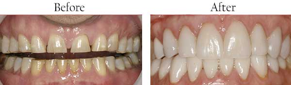 Before & After Photos by Mannheim Dental