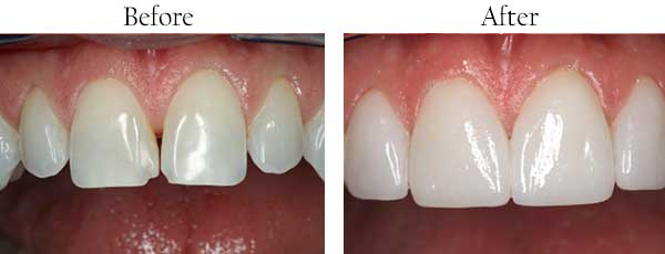 Before & After Photos by Mannheim Dental